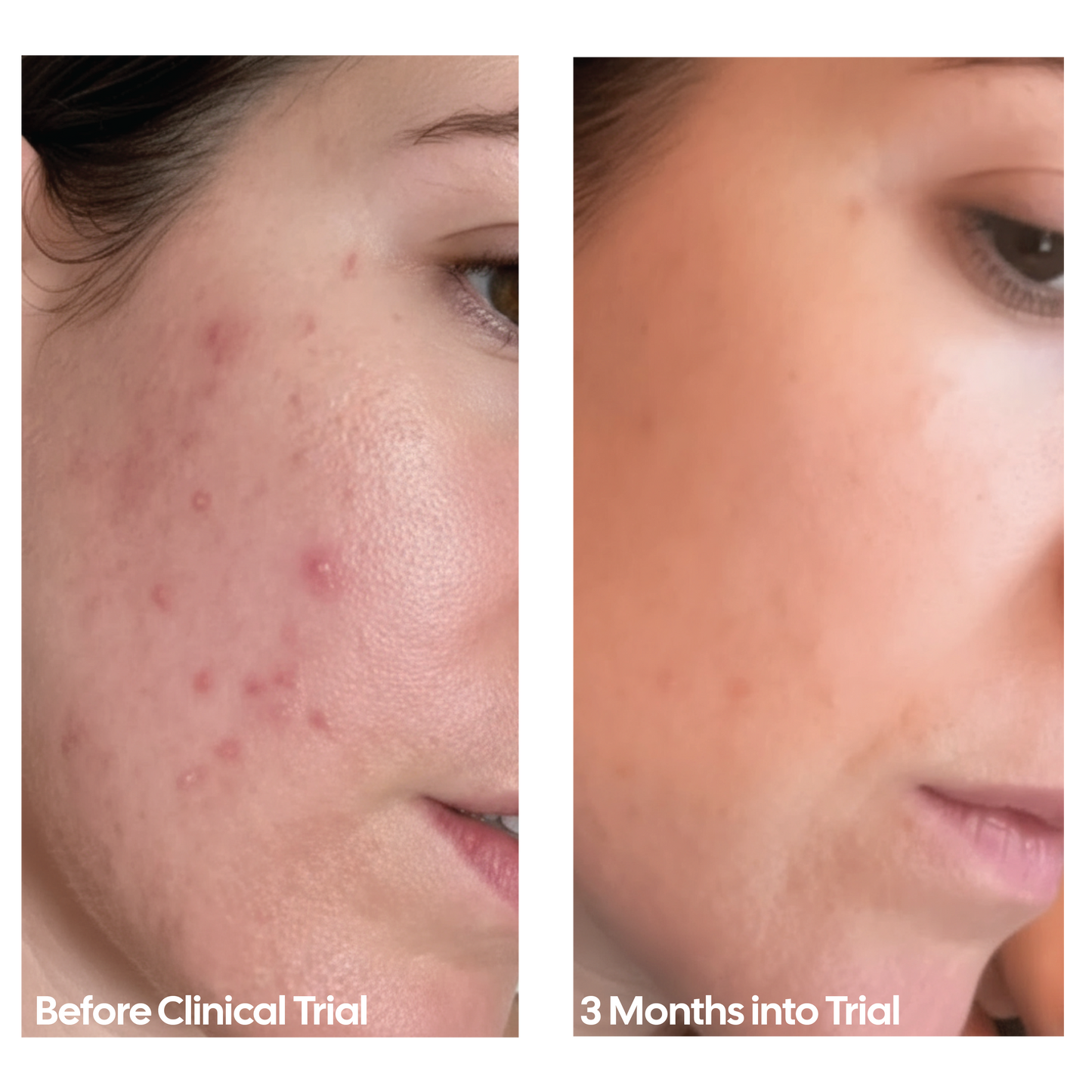 REDO Red Light Therapy Mask