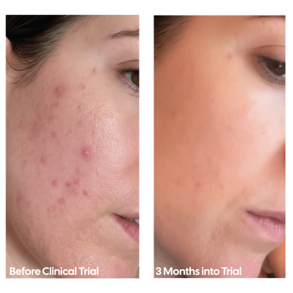 REDO Red Light Therapy Mask